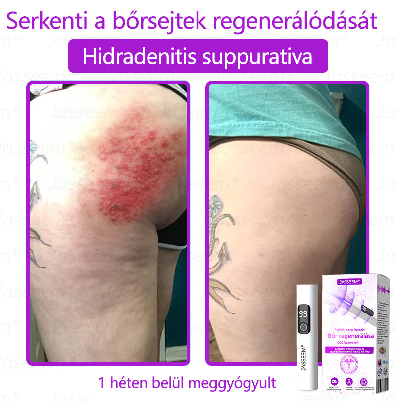 đđđŹđŹđđđŠÂź Fejlett, nem invazĂv bĆrjavĂtĂł COâ lĂ©zeres toll đ (GyengĂ©den eltĂĄvolĂtja a szemölcsöket, anyajegyeket, öregsĂ©gi foltokat Ă©s bĆrkinövĂ©seket â fĂĄjdalom Ă©s gond nĂ©lkĂŒl!)đ„