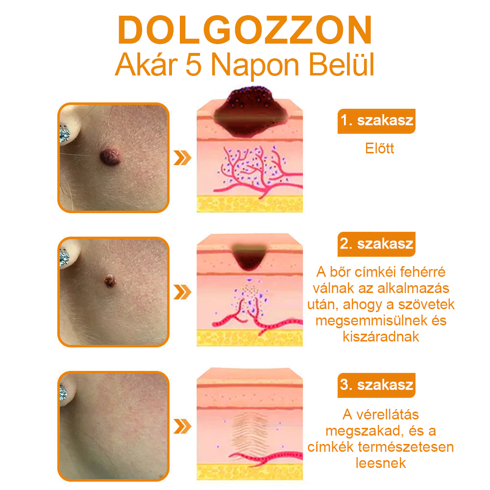 🌱🍯🐝BENETURE™ méhméreg szemölcs és anyajegy eltávolító krém (Utolsó napi akció, 80% kedvezmény)