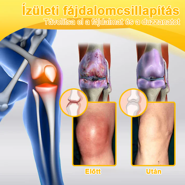 ✅TLOPA® Fájdalomcsillapító, csontregeneráló krém botulinum-toxinnal és méhméreggel 🐝