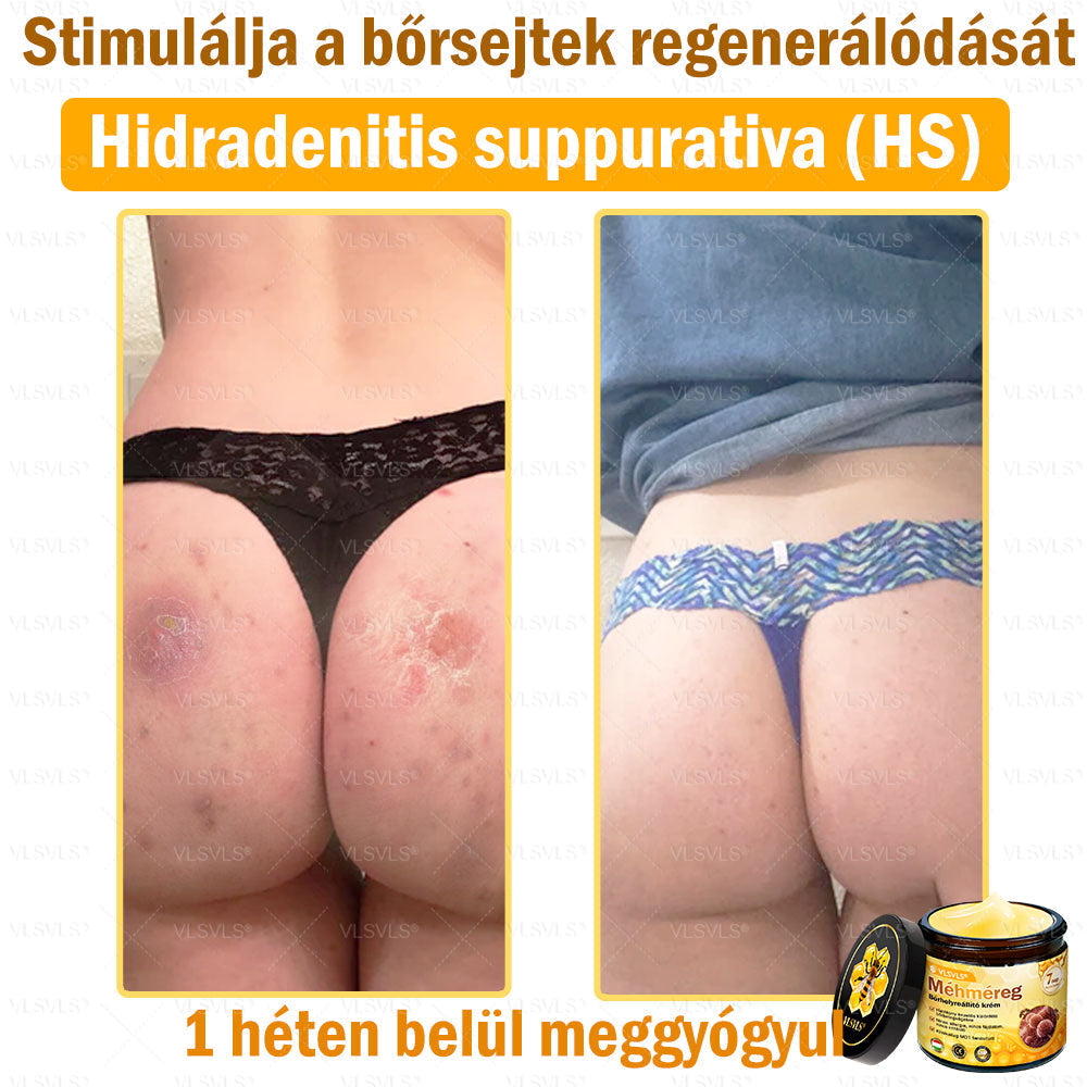 VLSVLS® Méhméreg Bőrhelyreállító Krém✅ – Utolsó nap! 80% kedvezmény 🔥