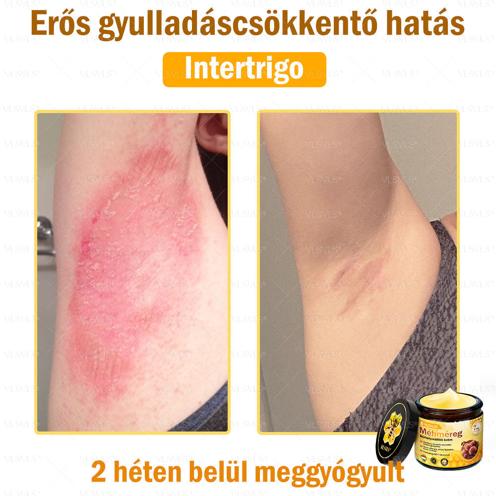 VLSVLS® Méhméreg Bőrhelyreállító Krém✅ – Utolsó nap! 80% kedvezmény 🔥