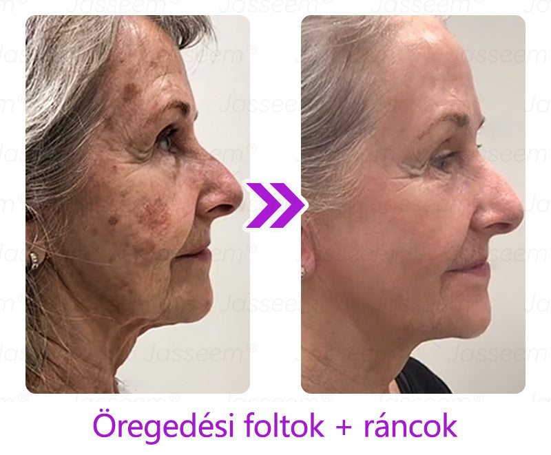đđđŹđŹđđđŠÂź Fejlett, nem invazĂv bĆrjavĂtĂł COâ lĂ©zeres toll đ (GyengĂ©den eltĂĄvolĂtja a szemölcsöket, anyajegyeket, öregsĂ©gi foltokat Ă©s bĆrkinövĂ©seket â fĂĄjdalom Ă©s gond nĂ©lkĂŒl!)đ„