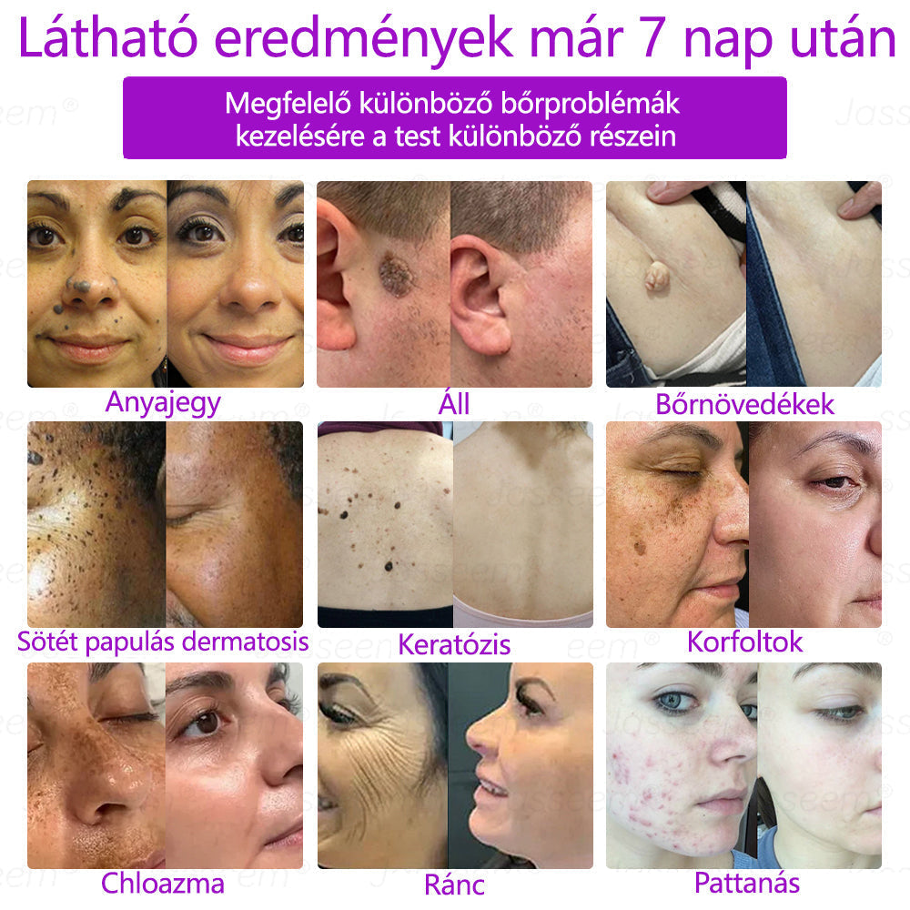 đđđŹđŹđđđŠÂź Fejlett, nem invazĂv bĆrjavĂtĂł COâ lĂ©zeres toll đ (GyengĂ©den eltĂĄvolĂtja a szemölcsöket, anyajegyeket, öregsĂ©gi foltokat Ă©s bĆrkinövĂ©seket â fĂĄjdalom Ă©s gond nĂ©lkĂŒl!)đ„
