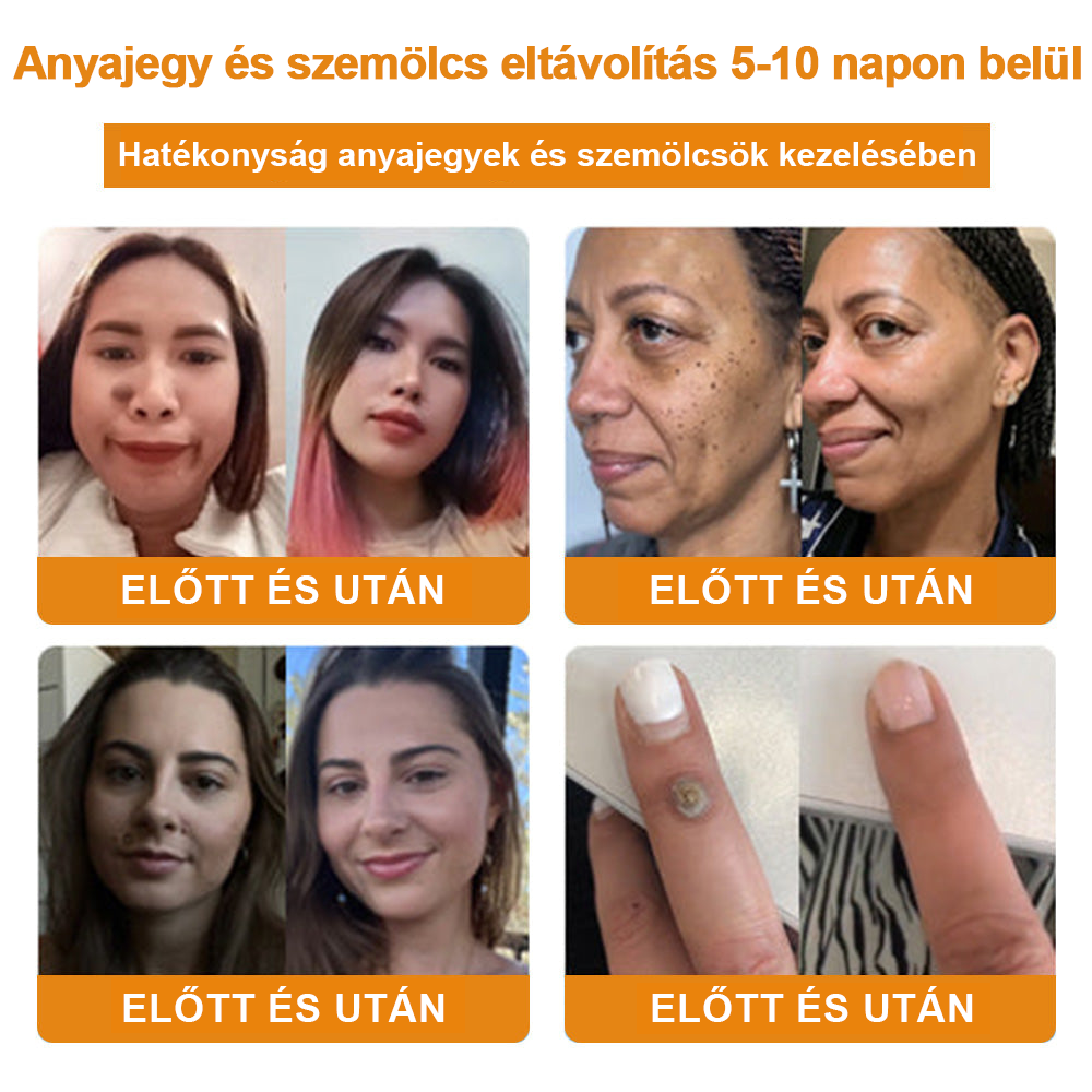 🌱🍯🐝BENETURE™ méhméreg szemölcs és anyajegy eltávolító krém (Utolsó napi akció, 80% kedvezmény)