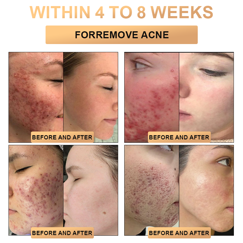 đ„đ„đ„PLTOWEâą Super Anti-Aging Creamđ„ KorlĂĄtozott idejƱ kedvezmĂ©ny UtolsĂł 30 perc (Minden korosztĂĄly szĂĄmĂĄra alkalmas)