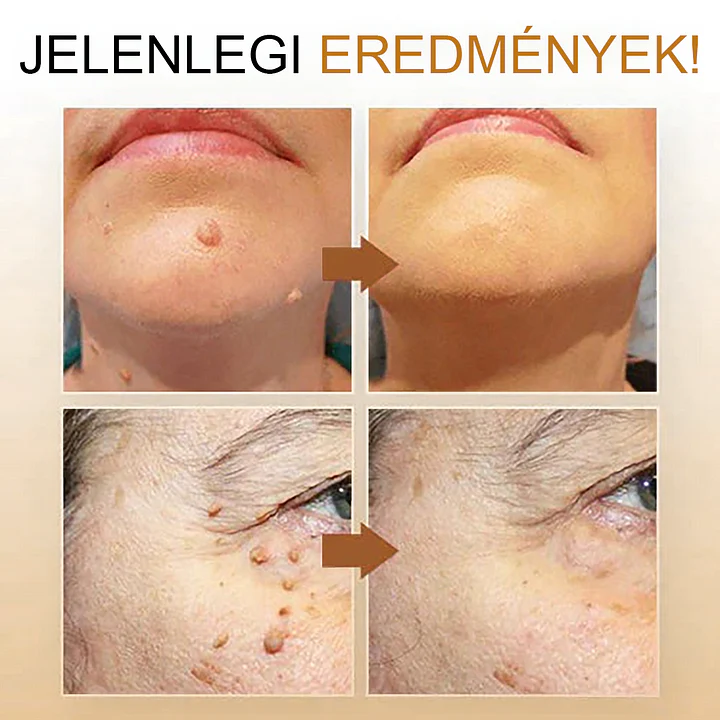đCvreoz spray szemölcsök Ă©s anyajegyek eltĂĄvolĂtĂĄsĂĄra mĂ©hmĂ©reggel (đšââDDG AJĂNLĂS)đđ(đ„utolsĂł napi ajĂĄnlat 80% kedvezmĂ©nnyel)