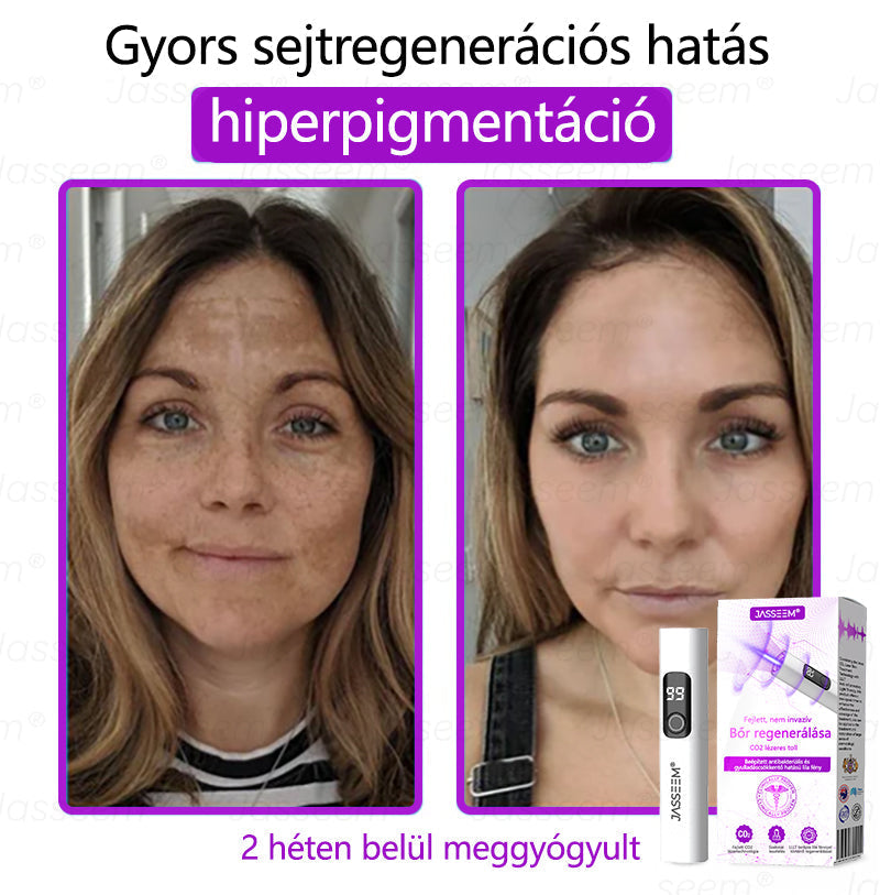 đđđŹđŹđđđŠÂź Fejlett, nem invazĂv bĆrjavĂtĂł COâ lĂ©zeres toll đ (GyengĂ©den eltĂĄvolĂtja a szemölcsöket, anyajegyeket, öregsĂ©gi foltokat Ă©s bĆrkinövĂ©seket â fĂĄjdalom Ă©s gond nĂ©lkĂŒl!)đ„