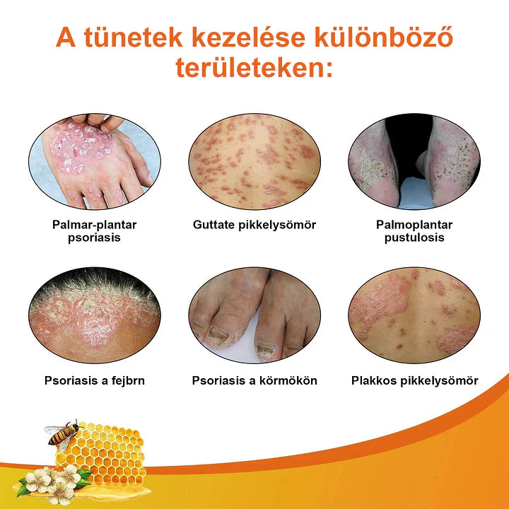 đCvreoz spray szemölcsök Ă©s anyajegyek eltĂĄvolĂtĂĄsĂĄra mĂ©hmĂ©reggel (đšââDDG AJĂNLĂS)đđ(đ„utolsĂł napi ajĂĄnlat 80% kedvezmĂ©nnyel)