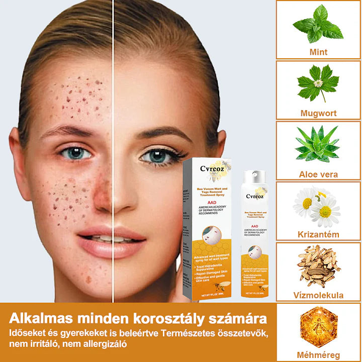 đCvreoz spray szemölcsök Ă©s anyajegyek eltĂĄvolĂtĂĄsĂĄra mĂ©hmĂ©reggel (đšââDDG AJĂNLĂS)đđ(đ„utolsĂł napi ajĂĄnlat 80% kedvezmĂ©nnyel)