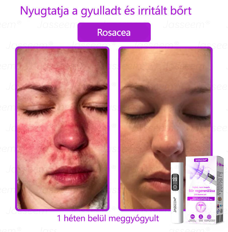 đđđŹđŹđđđŠÂź Fejlett, nem invazĂv bĆrjavĂtĂł COâ lĂ©zeres toll đ (GyengĂ©den eltĂĄvolĂtja a szemölcsöket, anyajegyeket, öregsĂ©gi foltokat Ă©s bĆrkinövĂ©seket â fĂĄjdalom Ă©s gond nĂ©lkĂŒl!)đ„