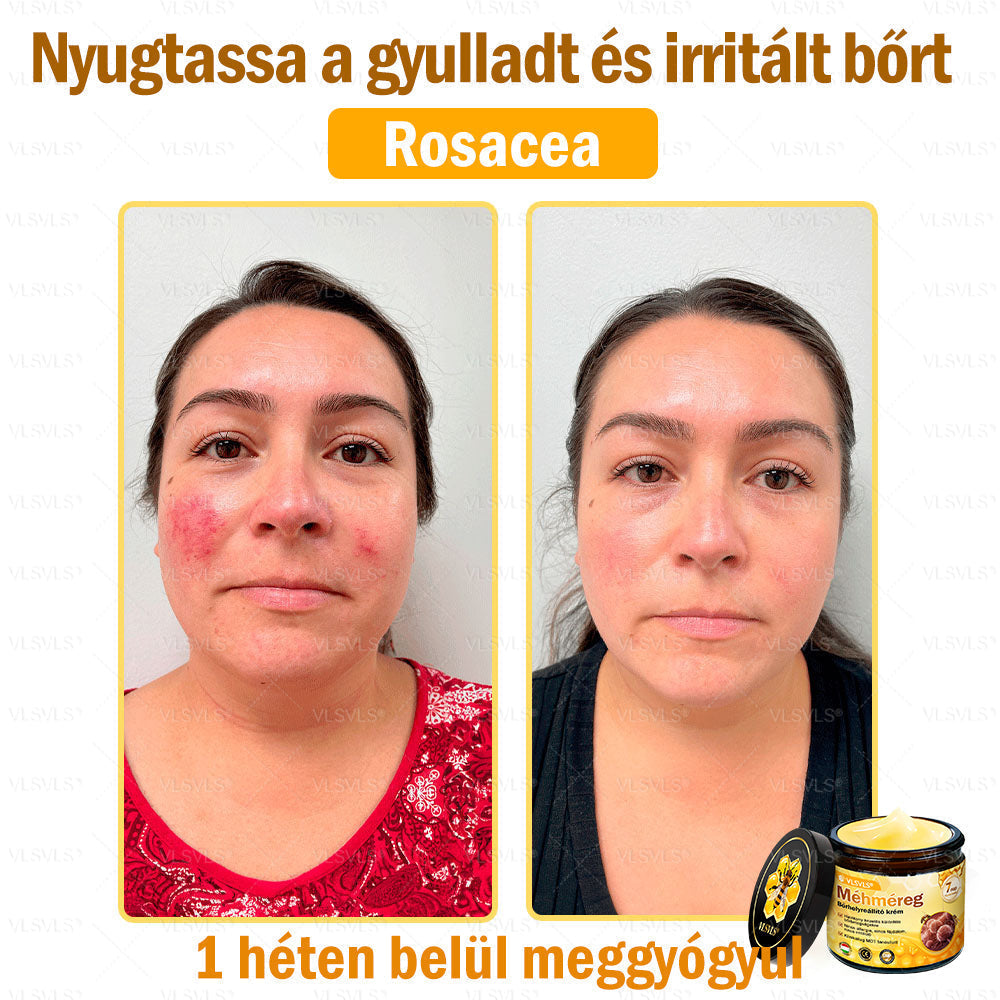 VLSVLS® Méhméreg Bőrhelyreállító Krém✅ – Utolsó nap! 80% kedvezmény 🔥