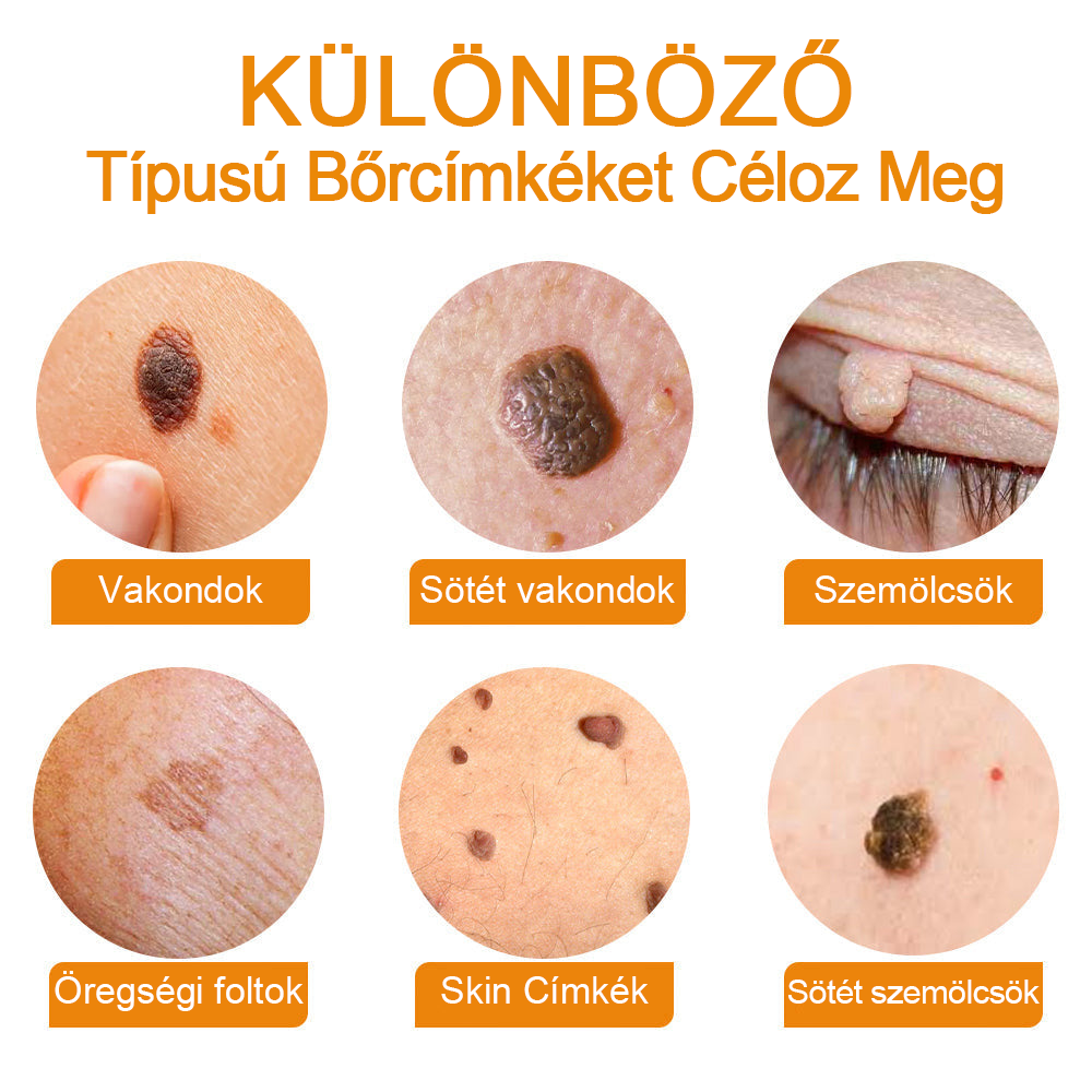 🌱🍯🐝BENETURE™ méhméreg szemölcs és anyajegy eltávolító krém (Utolsó napi akció, 80% kedvezmény)