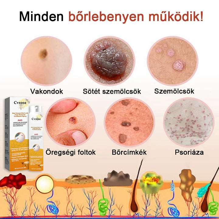 đCvreoz spray szemölcsök Ă©s anyajegyek eltĂĄvolĂtĂĄsĂĄra mĂ©hmĂ©reggel (đšââDDG AJĂNLĂS)đđ(đ„utolsĂł napi ajĂĄnlat 80% kedvezmĂ©nnyel)