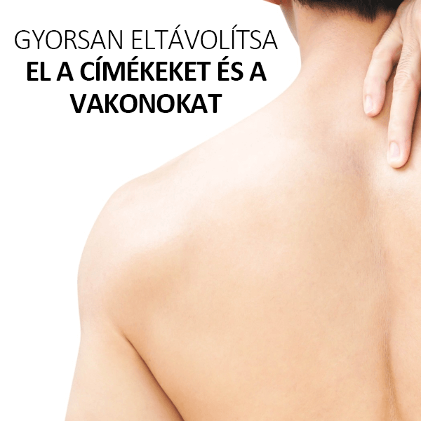 💎Cvreoz spray szemölcsök és anyajegyek eltávolítására méhméreggel (👨‍⚕DDG AJÁNLÁS)🐝🐝(🔥utolsó napi ajánlat 80% kedvezménnyel)