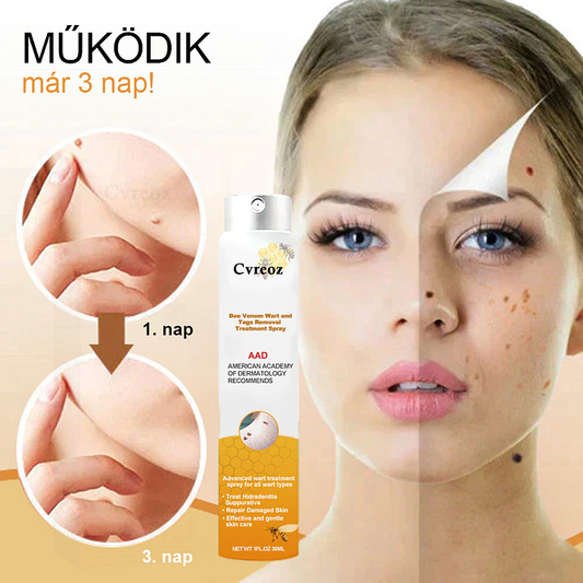 💎Cvreoz spray szemölcsök és anyajegyek eltávolítására méhméreggel (👨‍⚕DDG AJÁNLÁS)🐝🐝(🔥utolsó napi ajánlat 80% kedvezménnyel)