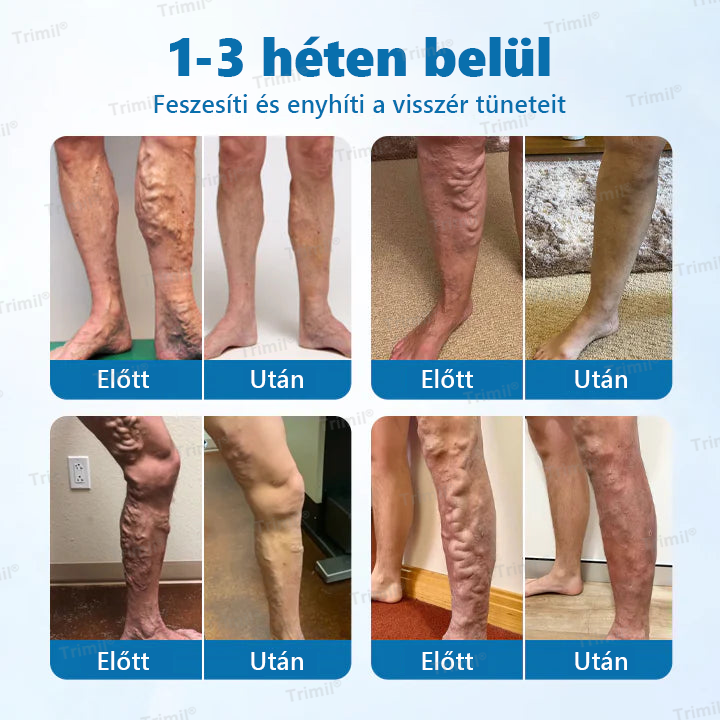 🌿Trimil® VeinGuard Gyógynövényes Spray - 👨‍⚕️ Klinikailag bizonyított, hogy mindössze 7 nap alatt megszünteti a visszereket!✨
