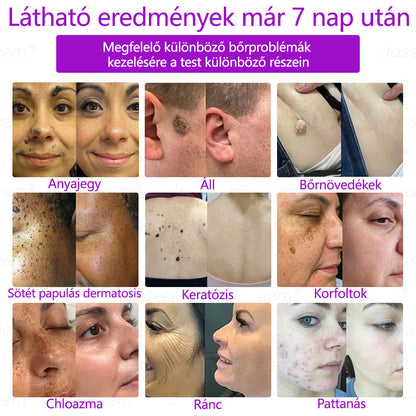 𝐉𝐚𝐬𝐬𝐞𝐞𝐦® Fejlett, nem invazív bőrjavító CO₂ lézeres toll 🎉 (Gyengéden eltávolítja a szemölcsöket, anyajegyeket, öregségi foltokat és bőrkinövéseket – fájdalom és gond nélkül!)🔥