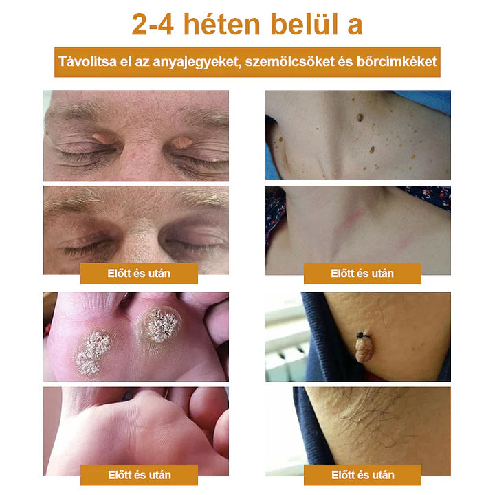 💎Cvreoz spray szemölcsök és anyajegyek eltávolítására méhméreggel (👨‍⚕DDG AJÁNLÁS)🐝🐝(🔥utolsó napi ajánlat 80% kedvezménnyel)
