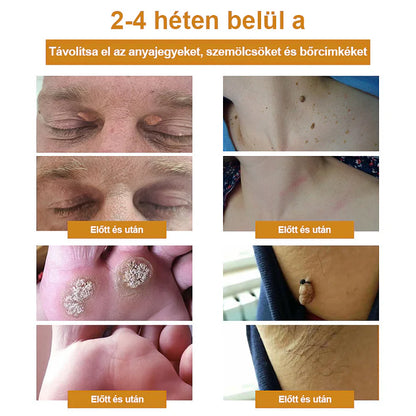 💎Cvreoz spray szemölcsök és anyajegyek eltávolítására méhméreggel (👨‍⚕DDG AJÁNLÁS)🐝🐝(🔥utolsó napi ajánlat 80% kedvezménnyel)