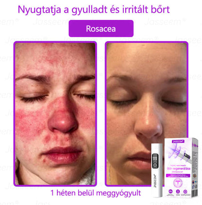 𝐉𝐚𝐬𝐬𝐞𝐞𝐦® Fejlett, nem invazív bőrjavító CO₂ lézeres toll 🎉 (Gyengéden eltávolítja a szemölcsöket, anyajegyeket, öregségi foltokat és bőrkinövéseket – fájdalom és gond nélkül!)🔥