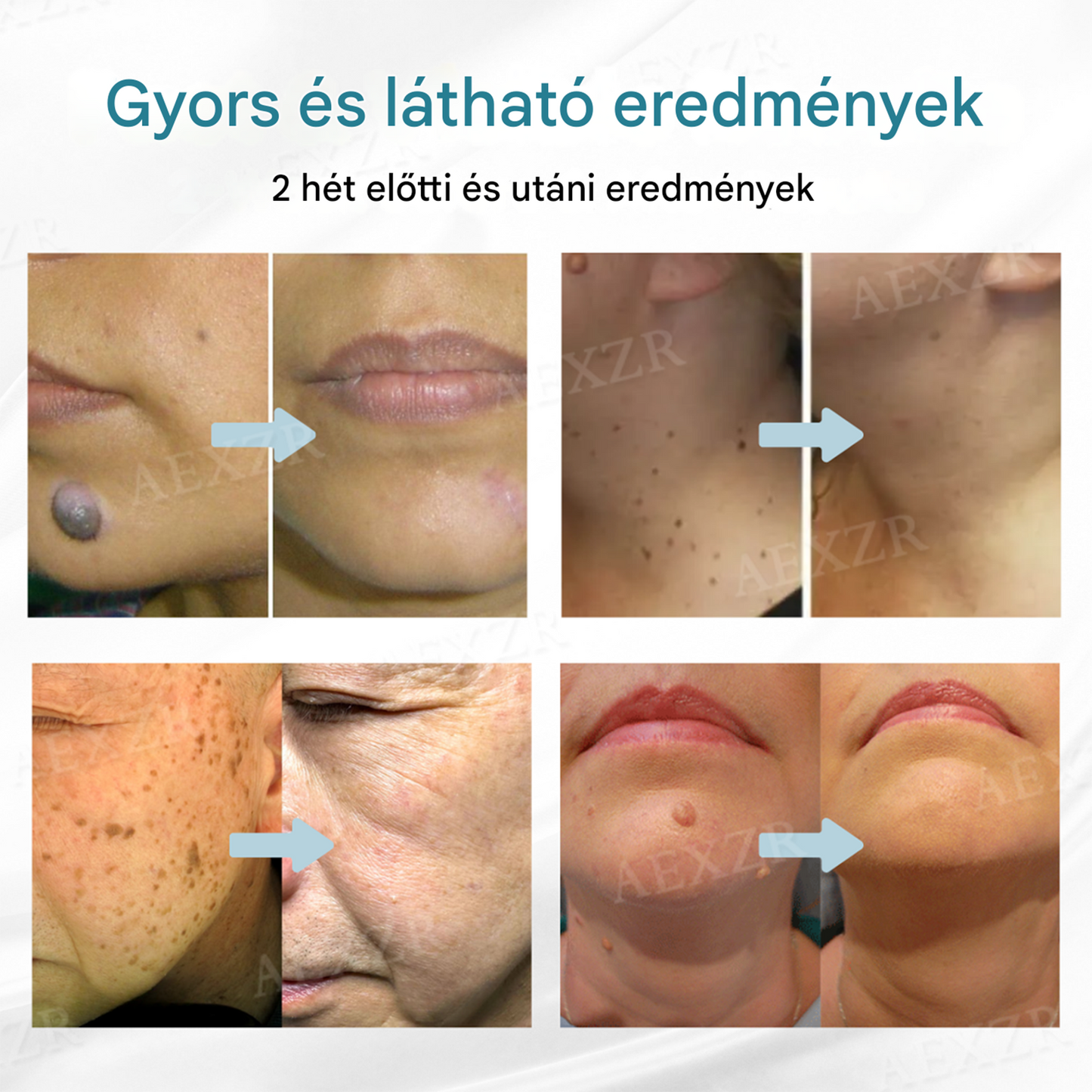 Bikenda® non-invazív anyajegy- és szemölcseltávolító lézertoll🌟